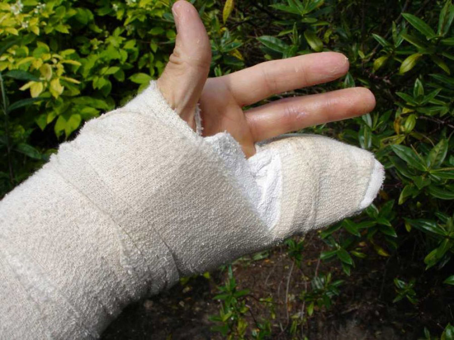 It takes time to recover from dropping a railway sleeper onto your hand